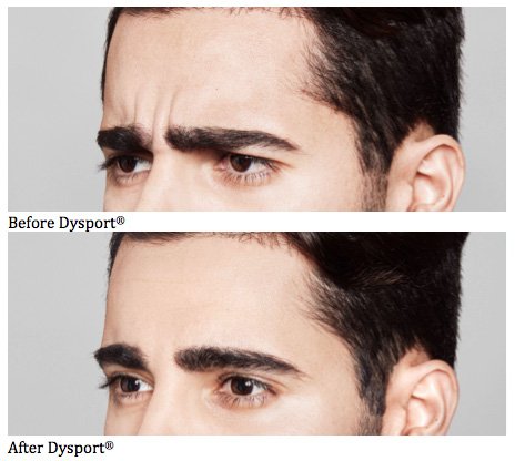 Dysport - Before and After 1