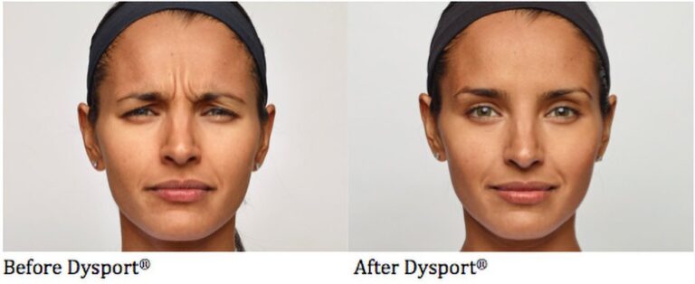 Dysport-Before_After-2