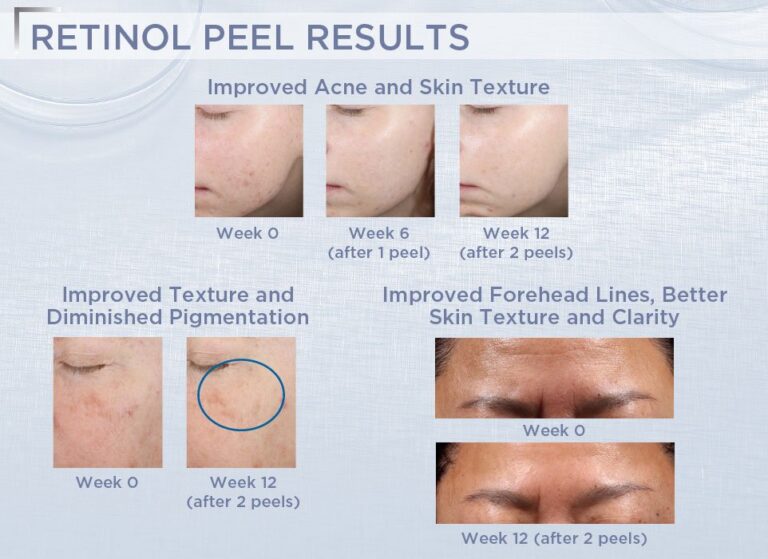 NeoStrata-Retinol-Peel-B_A