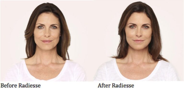 Before and After Radiesse