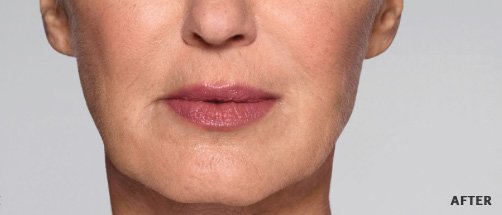Restylane-ReFyne-After