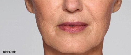 Restylane-ReFyne-Before